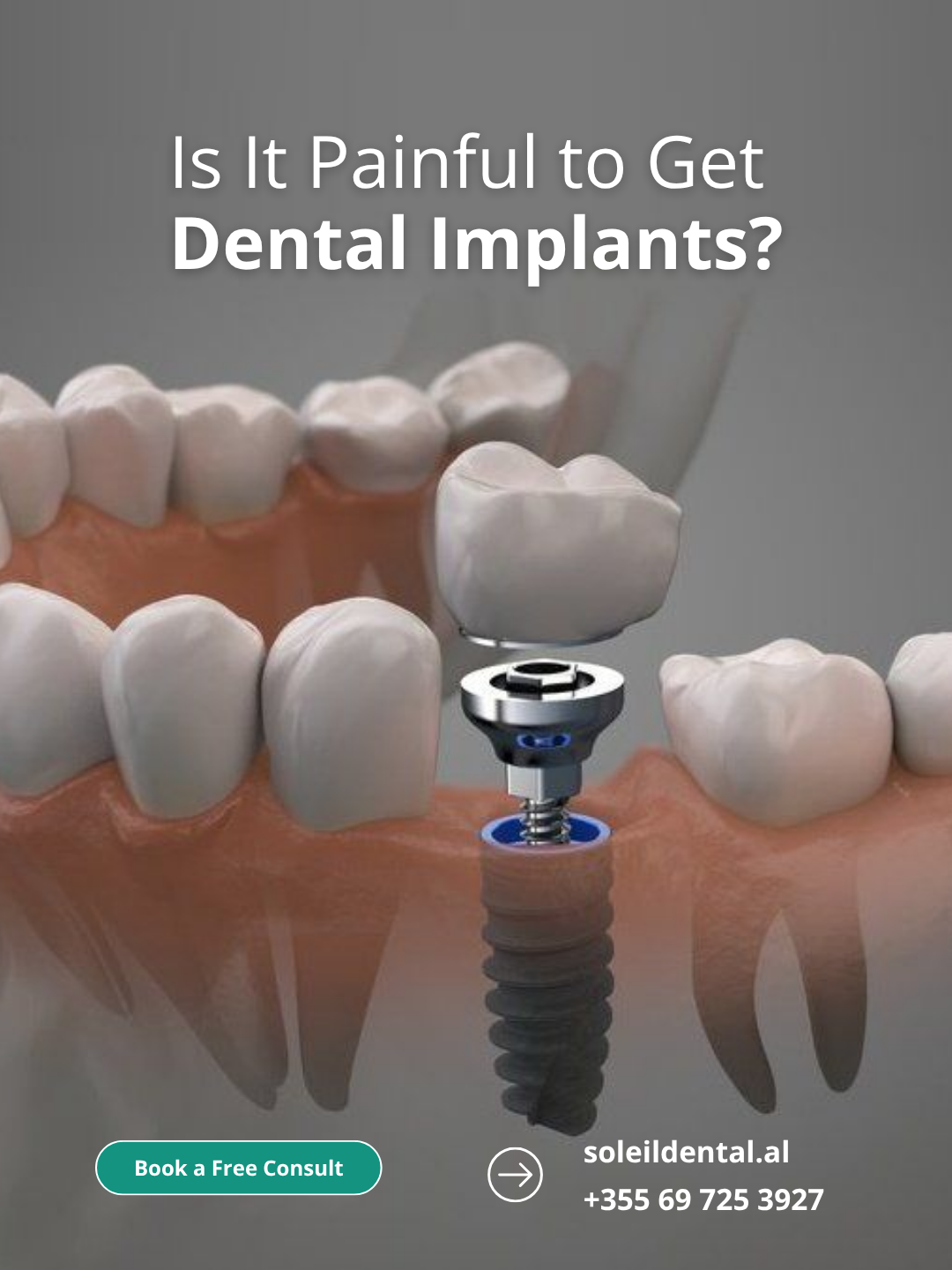 Is It Painful to Get Dental Implants