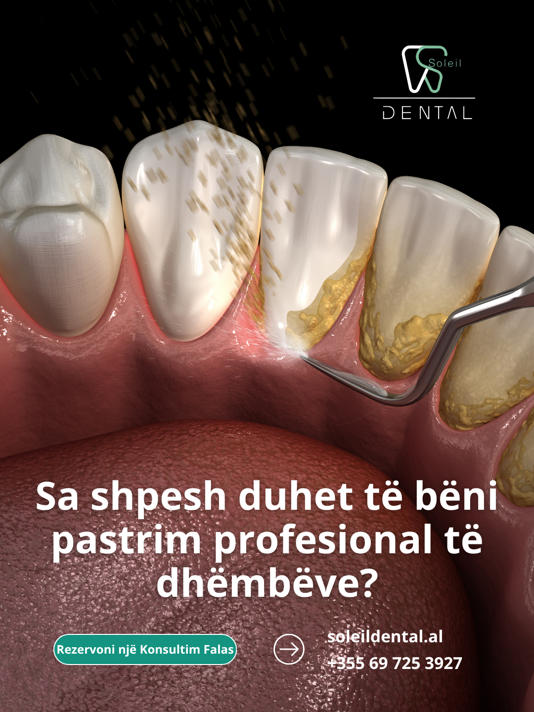 Sa shpesh duhet të bëni pastrim profesional të dhëmbëve