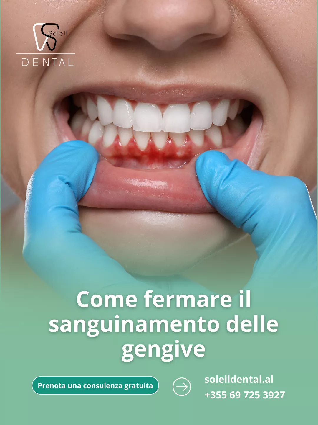 Come fermare il sanguinamento delle gengive: cause, trattamenti e consigli per la prevenzione