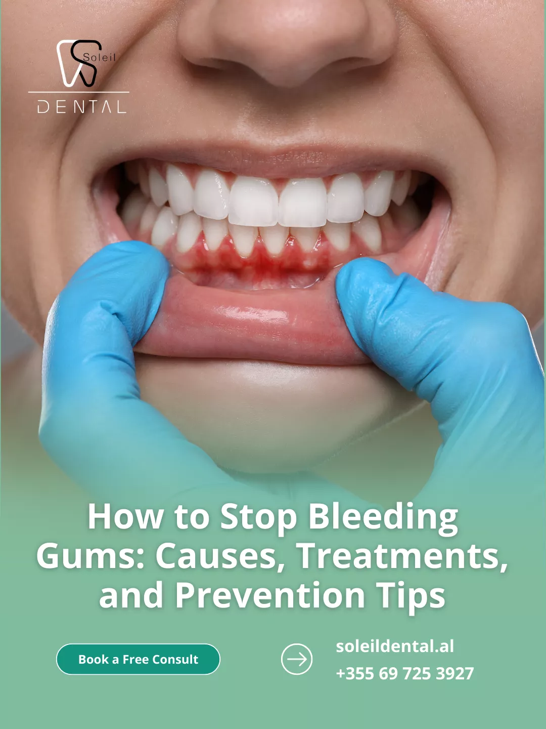 How to Stop Bleeding Gums: Causes, Treatments, and Prevention Tips